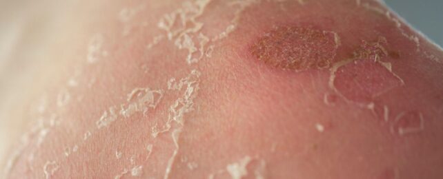 A Rare, Fatal Skin Disease Has Been Cured in Patients For The First Time