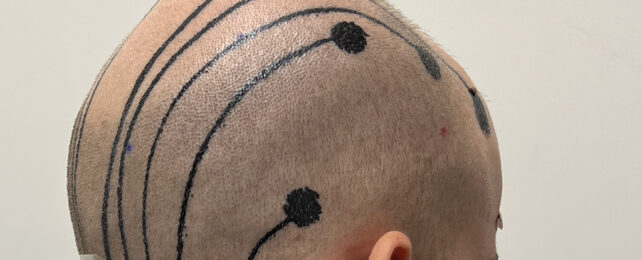 These Temporary Electronic Tattoos Can Measure Your Brain Activity